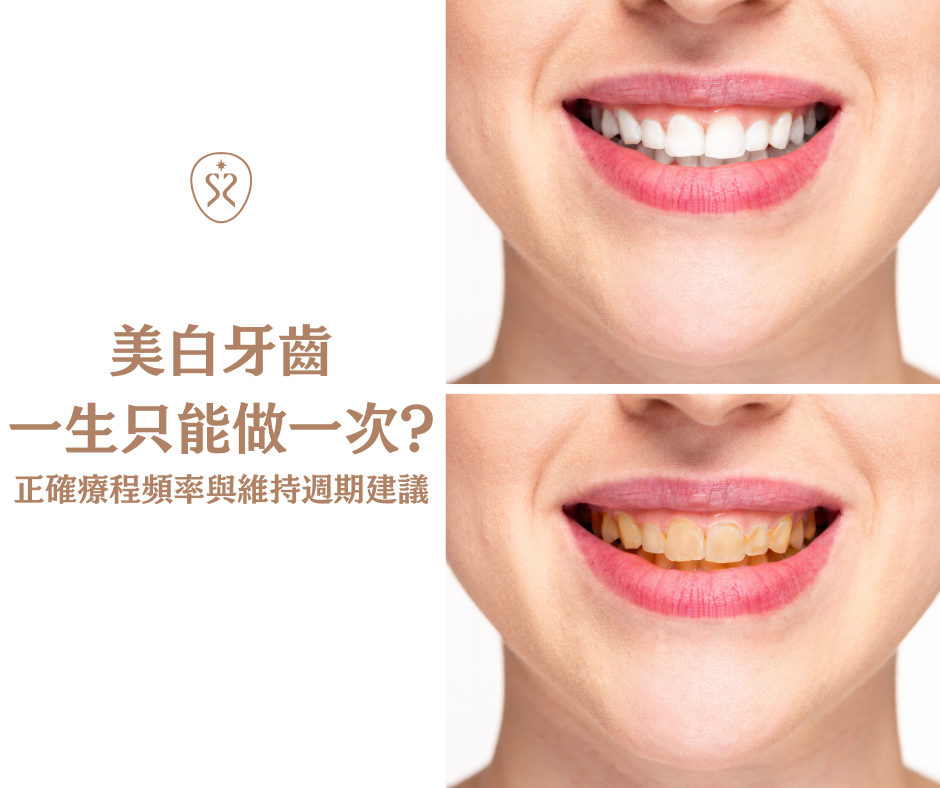 美白牙齒迷思二：美白牙齒只能做一次？正確療程頻率與維持週期建議